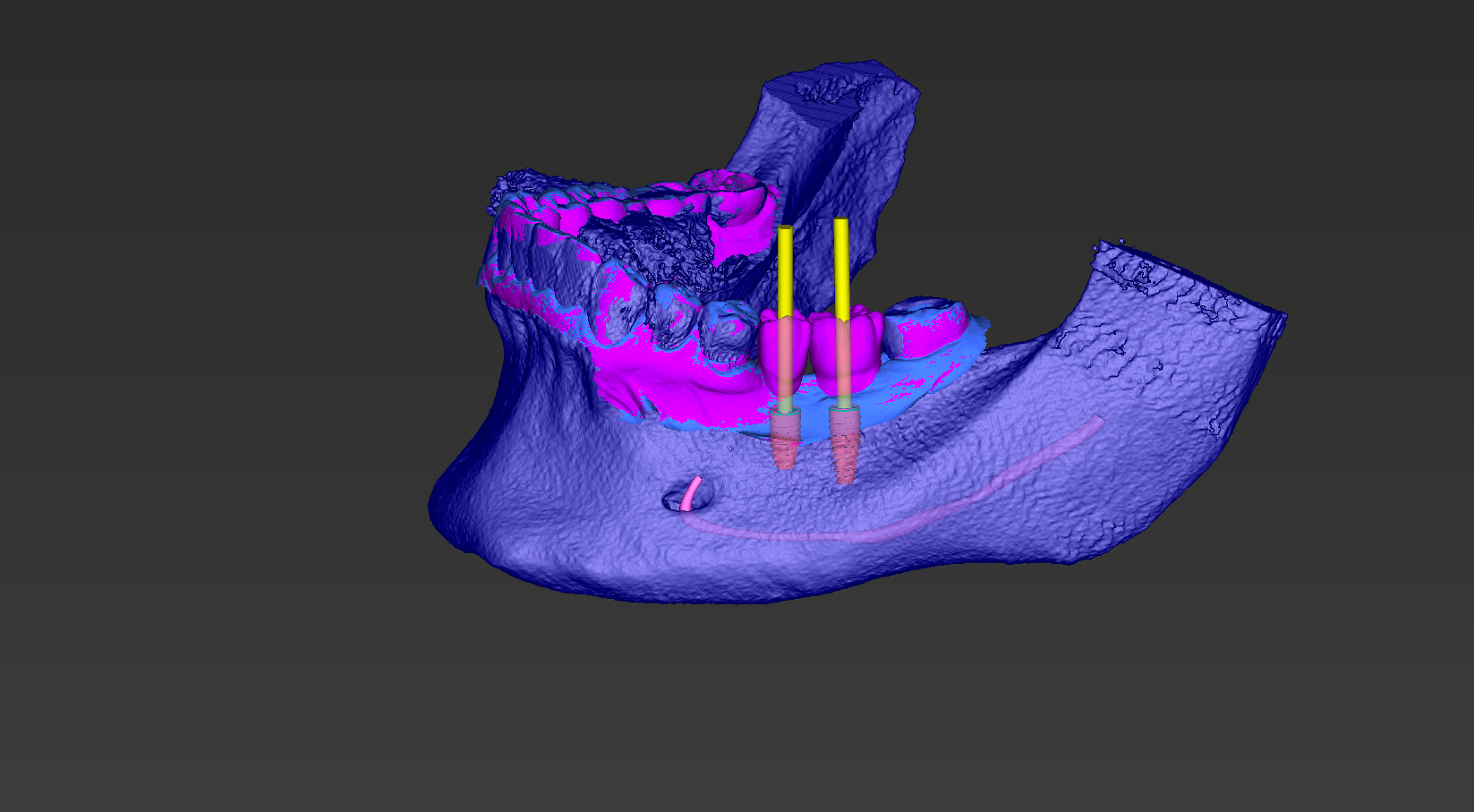 Implantologia Dentale: ripristina il tuo sorriso e la funzionalità dentale
