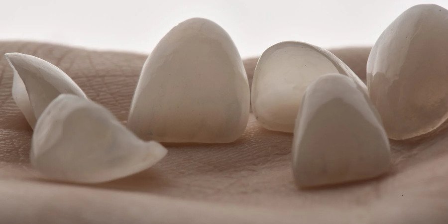 faccette dentali bologna