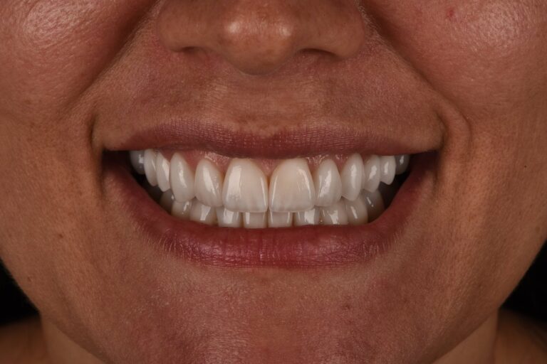 Faccette Dentali - 01 - Dopo