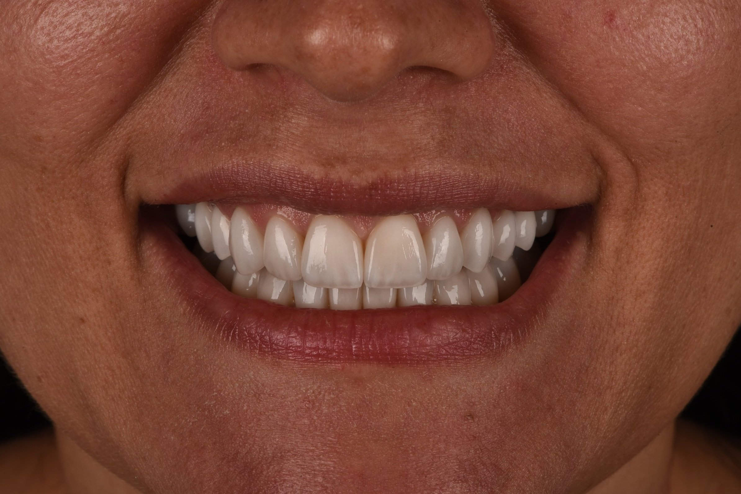 Faccette Dentali - 01 - Dopo