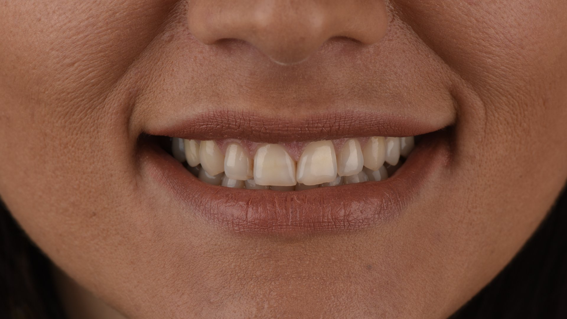 Faccette Dentali - 01 - Prima