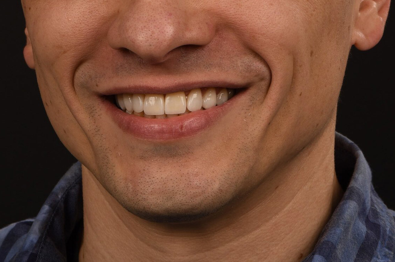 faccette dentali 02 dopo