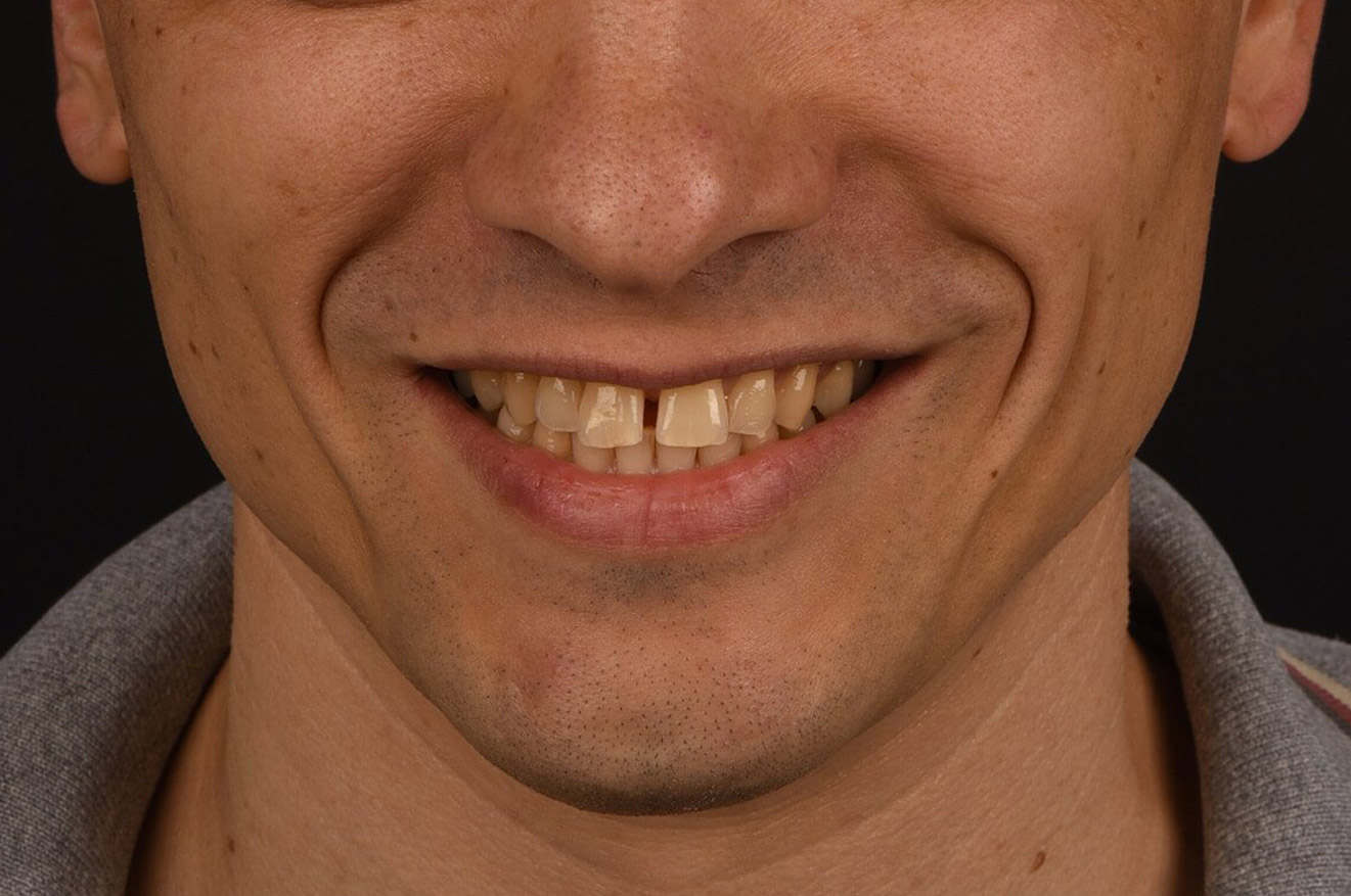 faccette dentali 02 prima