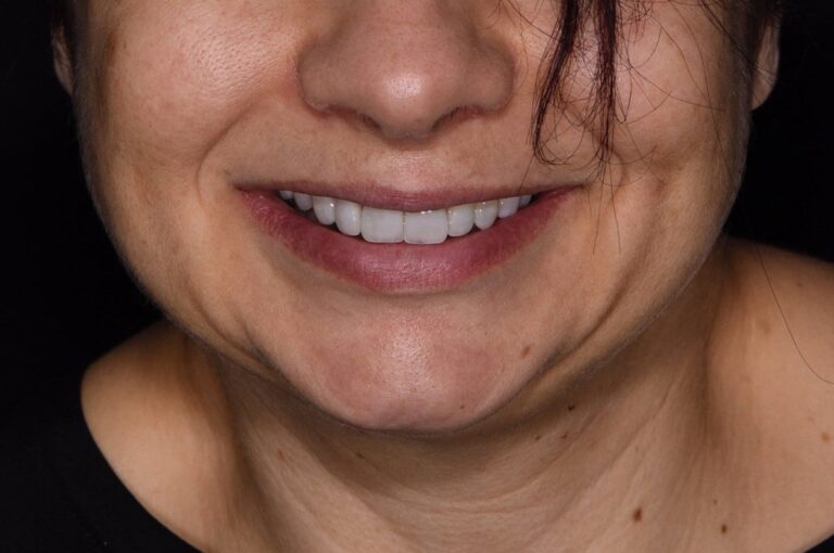 Faccette Dentali - 03 - Dopo