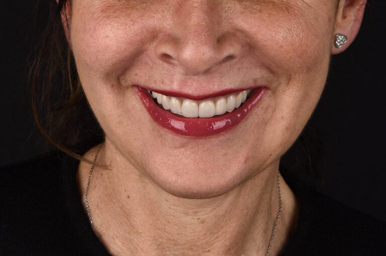 Faccette Dentali - 04 - Dopo