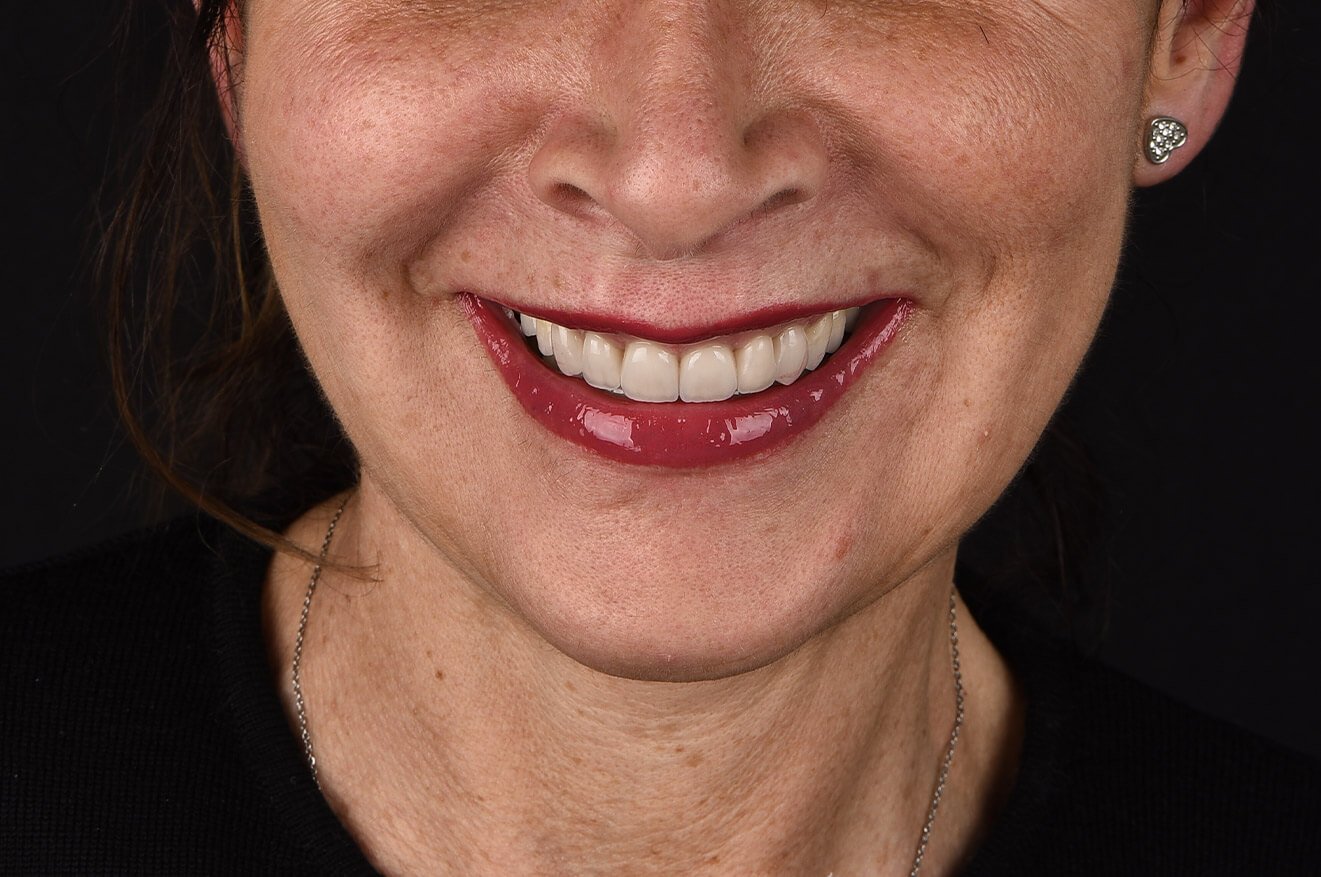 Faccette Dentali - 04 - Dopo