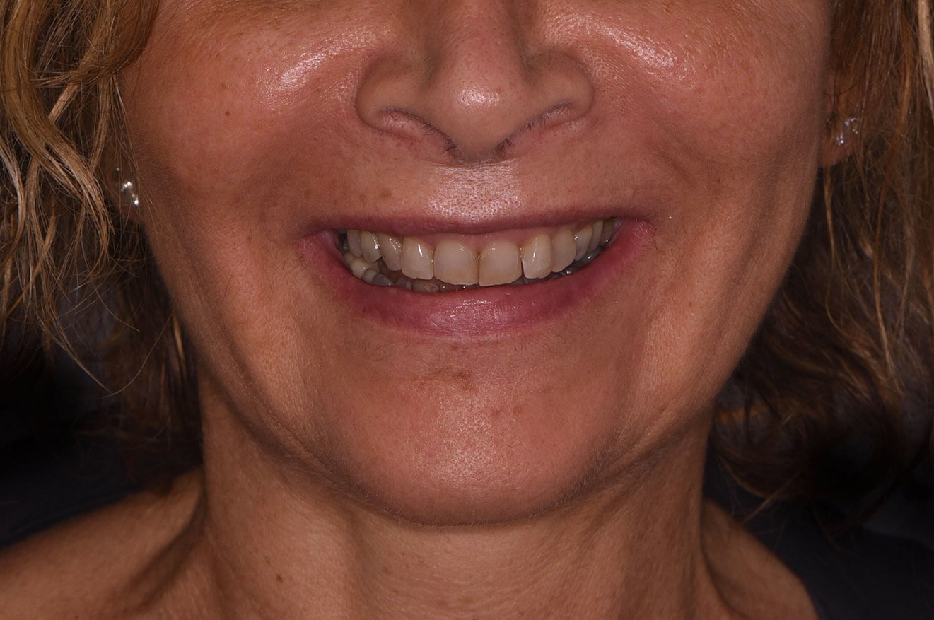 Faccette Dentali - 04 - Prima