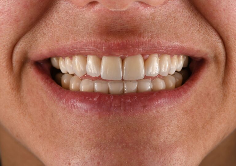Faccette Dentali - 05 - Dopo