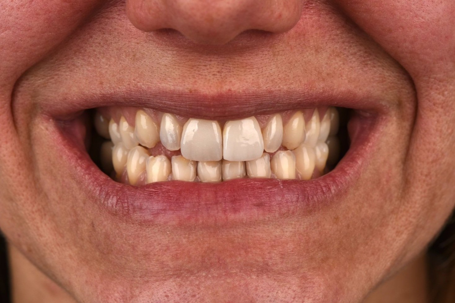 Faccette Dentali - 05 - Prima