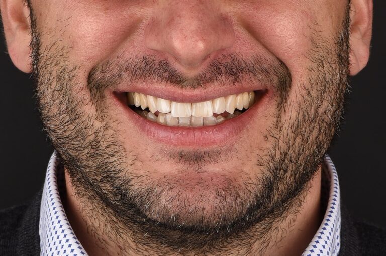 Implantologia Dentale - Caso 01 - dopo
