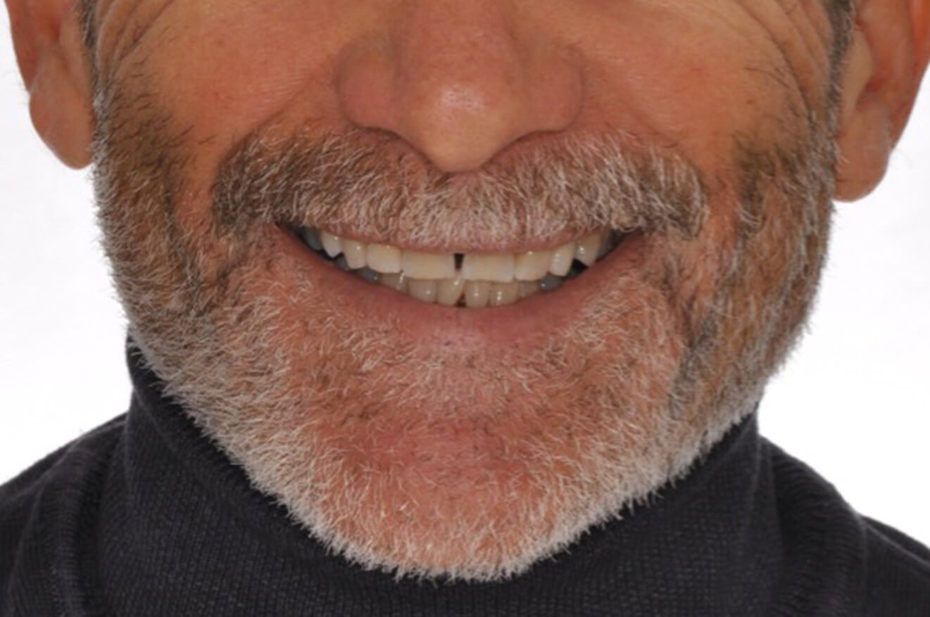 Implantologia Dentale - Caso 02 - dopo