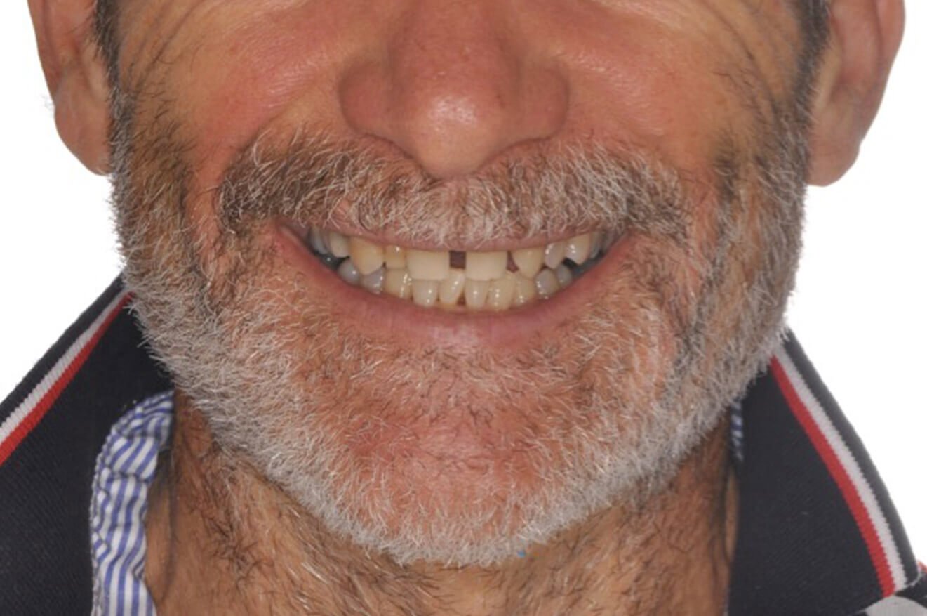 Implantologia Dentale - Caso 02 - prima