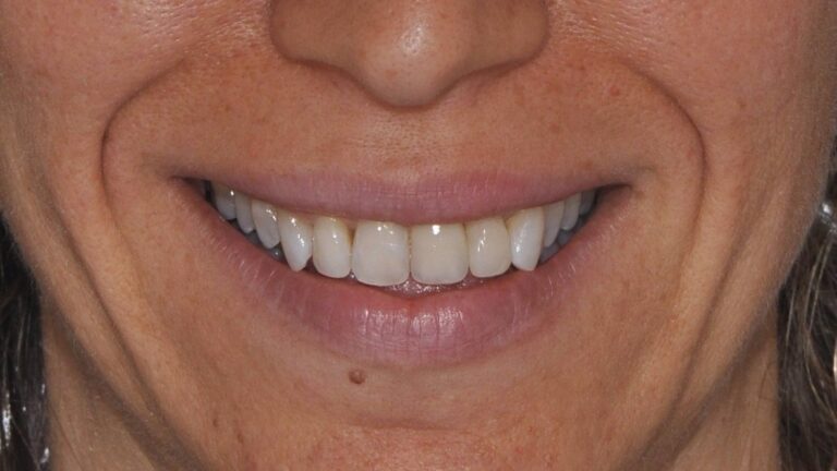 Implantologia Dentale - Caso 03 - dopo