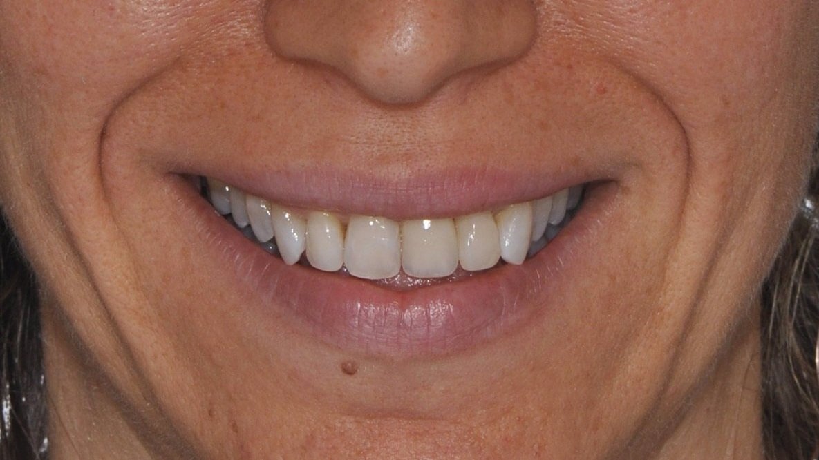 Implantologia Dentale - Caso 03 - dopo