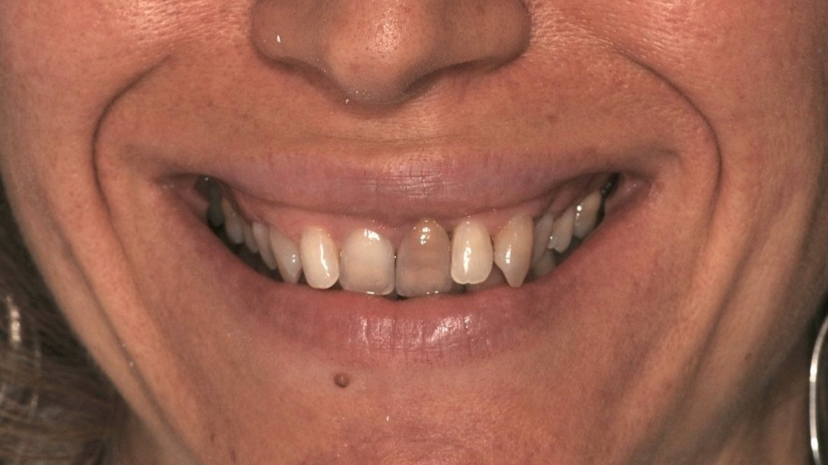 Implantologia Dentale - Caso 03 - prima