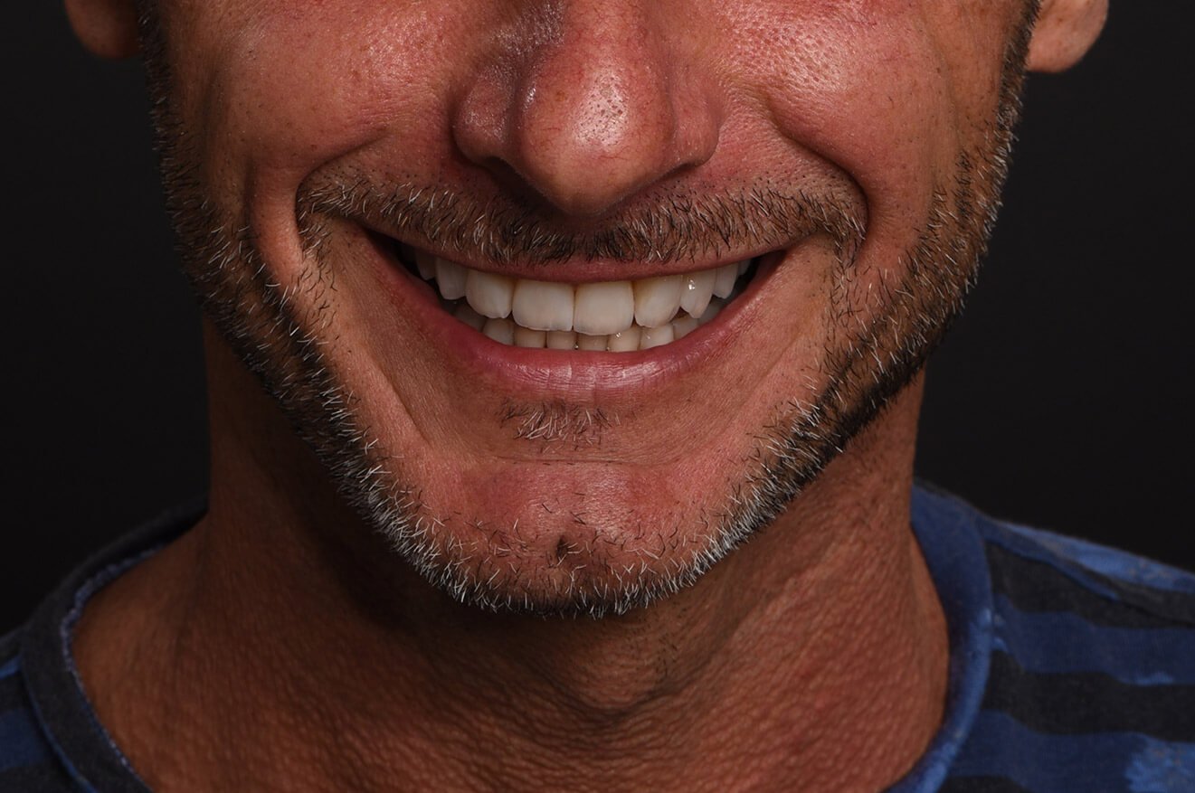 Implantologia Dentale - Caso 04 - dopo