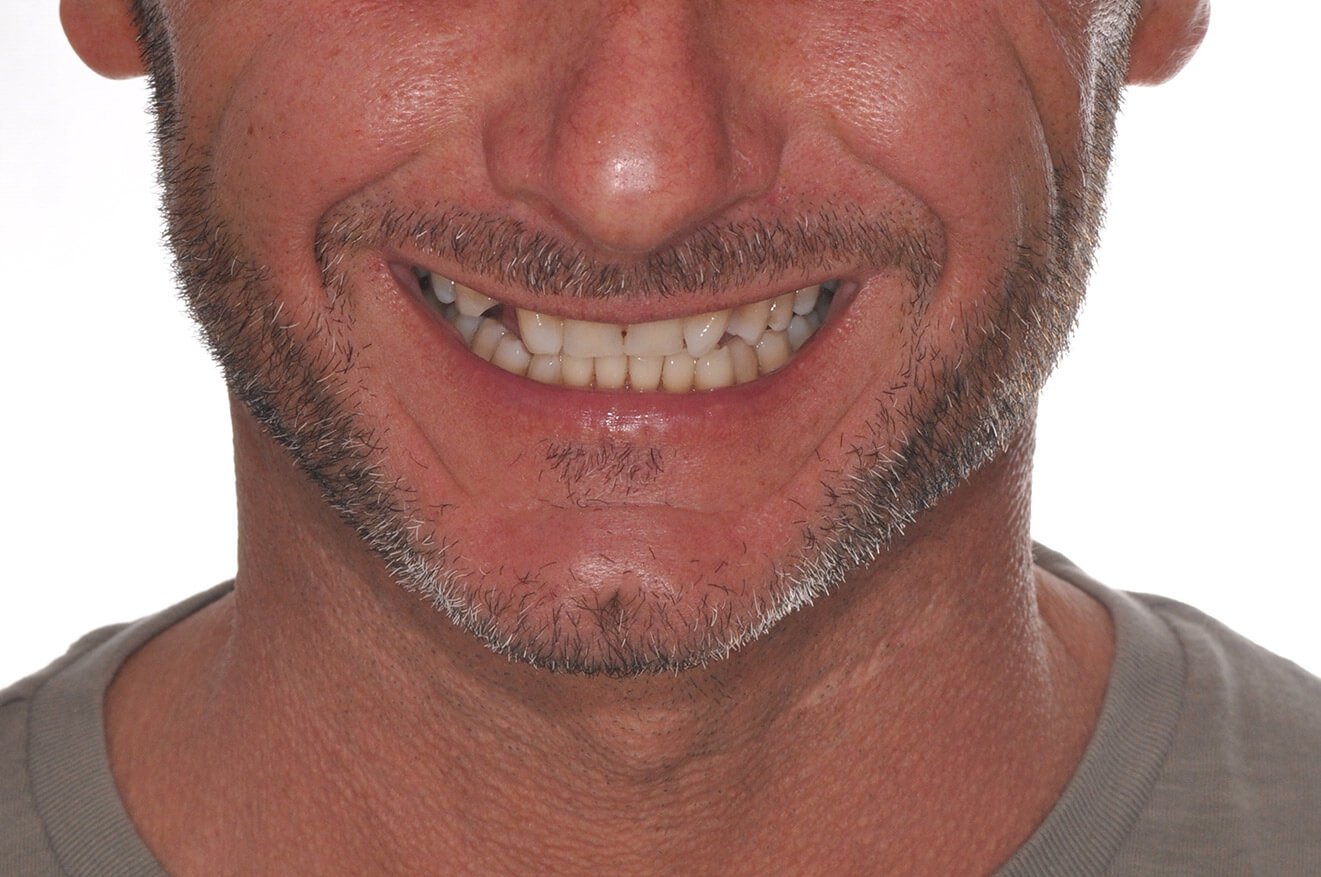 Implantologia Dentale - Caso 04 - prima