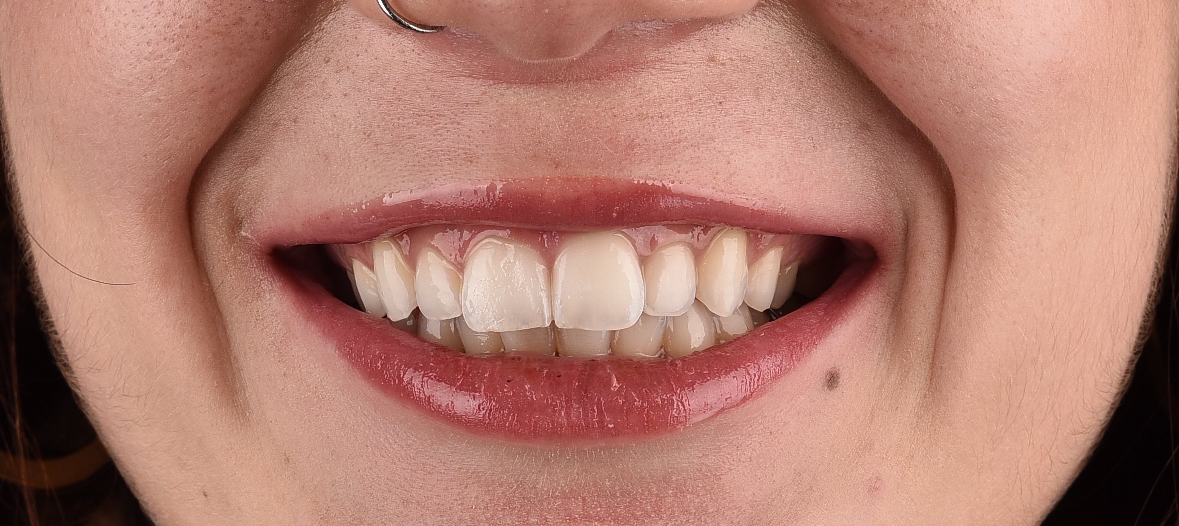 Sbiancamento dentale: procedure e benefici