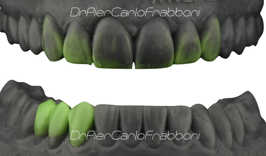 estetica dentale bologna - Ceratura digitale