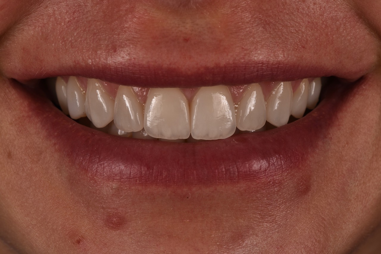 denti usurati, faccette dentali - dopo