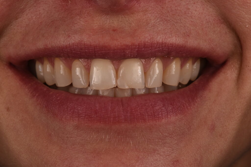 denti usurati, faccette dentali - prima