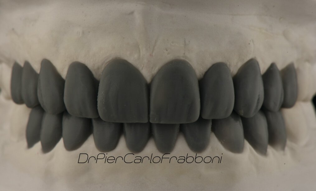 estetica dentale bologna - Ceratura a mano