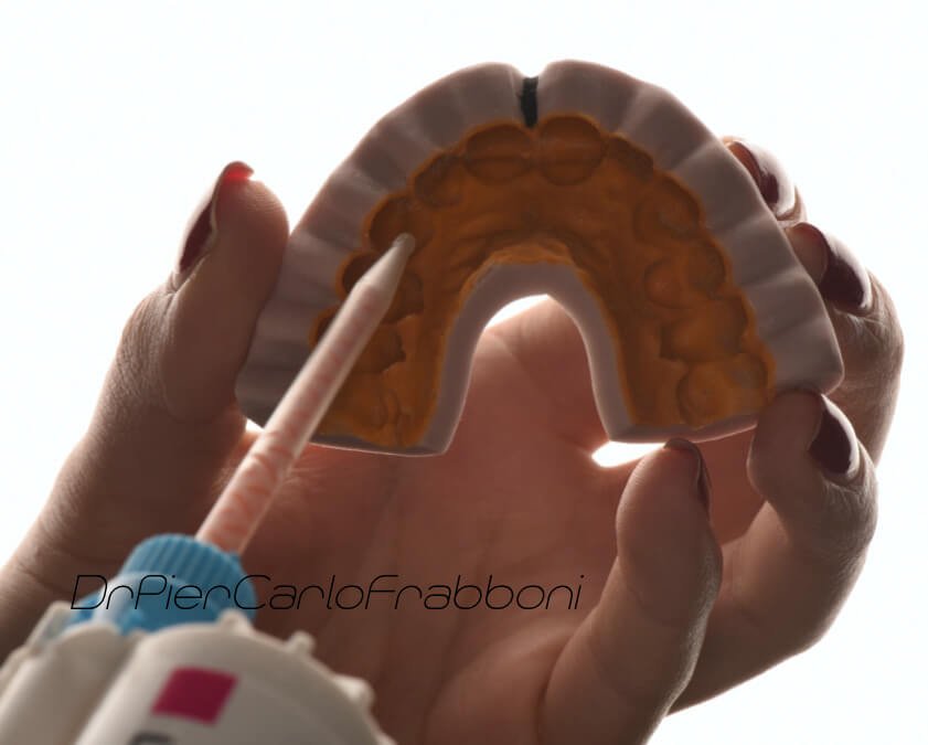 estetica dentale bologna - Inserimento resina estetica